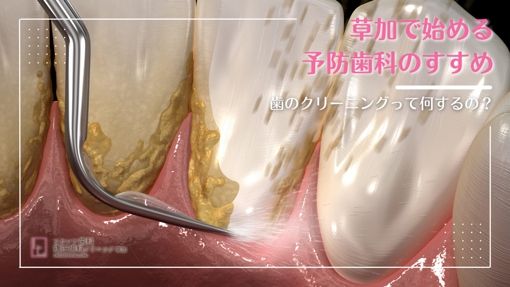 本当のPMTCその意味と価値 歯科 ペリオ 本当のPMTCその意味と価値